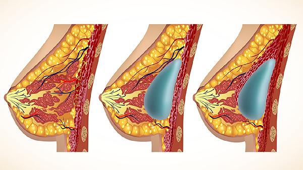 氣管內(nèi)腫瘤時出現(xiàn)什么癥狀