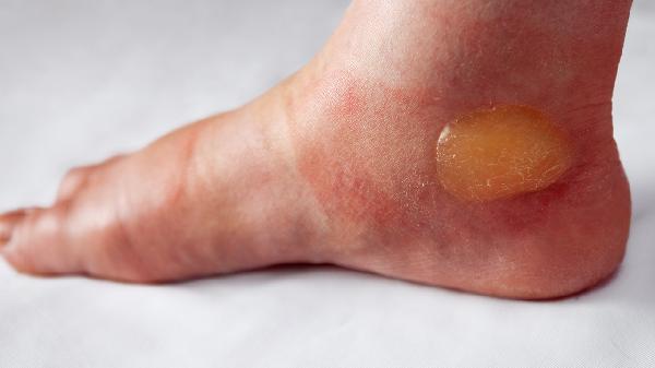 手指起了很多小水泡很癢怎么辦