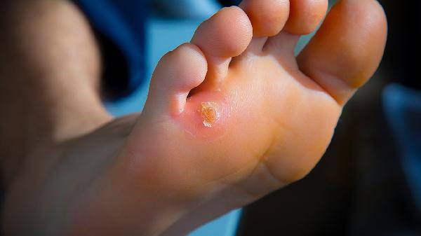 雞眼不管它自己能好嗎 介紹雞眼的幾個(gè)治愈方法