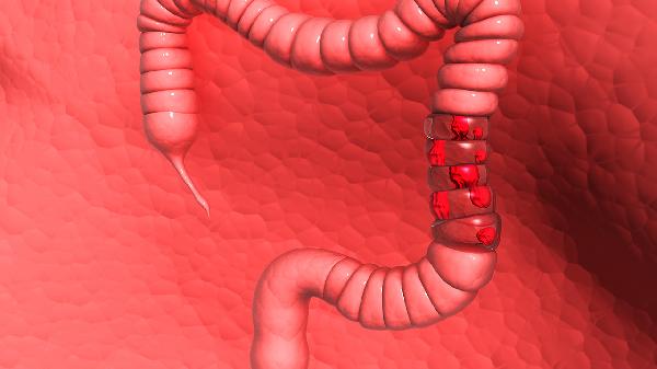 潰瘍性結(jié)腸炎激素治療效果如何