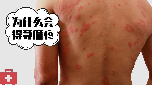 蕁麻疹的中醫(yī)治療思路與方法有哪些