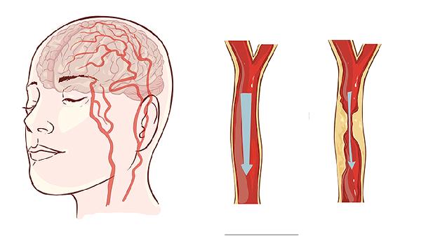 腦血管病人怎么康復訓練 腦血管病人的4個康復訓練方法揭曉