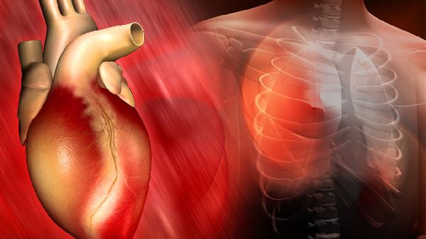 急性心肌梗死怎么回事 浅析急性心肌梗死的三个原因