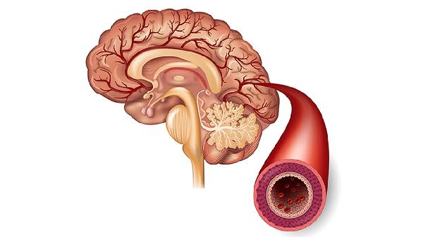 腦瘤有什么癥狀表現(xiàn) 腦瘤的五個(gè)表現(xiàn)要重視
