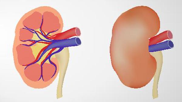 系膜毛細血管性腎小球腎炎怎么回事