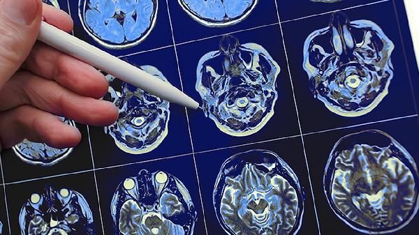 新生兒腦積水怎么引起的 新生兒腦積水的幾個引發(fā)原因須知