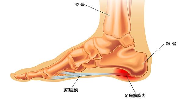 跟骨骨折的常見原因有哪些 跟骨骨折4個常見病因分析