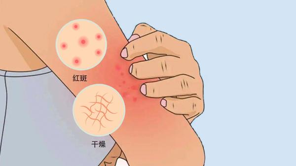 委中穴放血治療皮膚病真的嗎