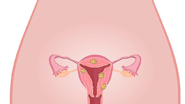 老年女性得宮頸癌有什么癥狀 宮頸癌五大癥狀不可忽視