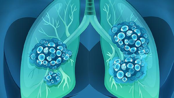 臨床腫瘤治療中中性粒細胞減少的治療方法有哪些