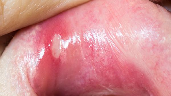 反復(fù)性口腔潰瘍?cè)趺崔k 反復(fù)性口腔潰瘍的改善方法分享