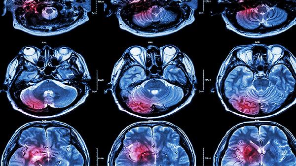 脑梗死需要做手术吗   介绍脑梗死的手术适应症