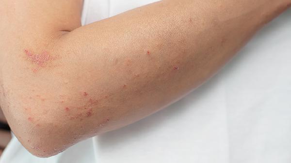 蕁麻疹惡化成紅斑狼瘡怎么回事，怎么辦