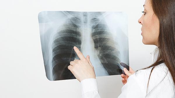 肋軟骨炎怎么引起的 肋軟骨炎的四個病因淺析