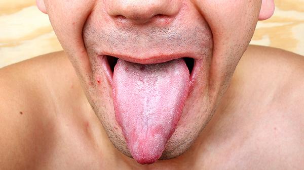 龜頭潰瘍?cè)趺崔k 揭曉龜頭潰瘍的正確處理方法