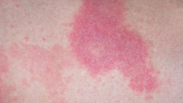 体癣和股癣有什么区别  注意3细节区分体癣和股癣