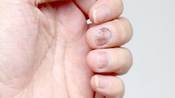 突然有斷層的黃指甲就右腳大拇指怎么回事