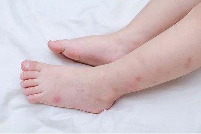7歲孩子身上起小疙瘩癢怎么回事