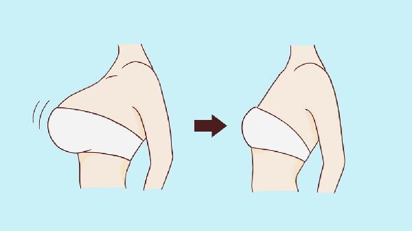 巨乳缩小手术需要注意什么