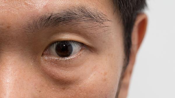 甲亢眼睛突出怎么恢复 三个恢复方法改善甲亢眼睛突出