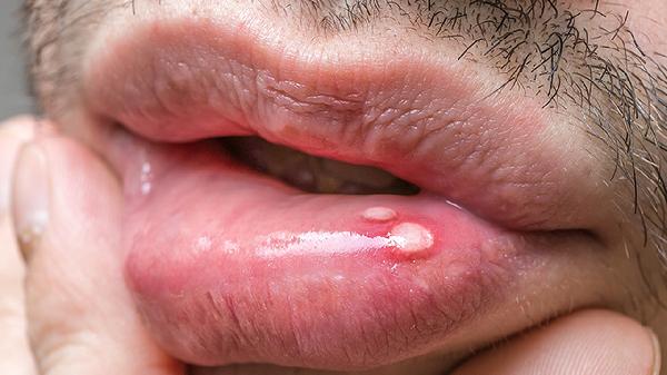 口角炎怎么分类 认识四种不同类型的口角炎