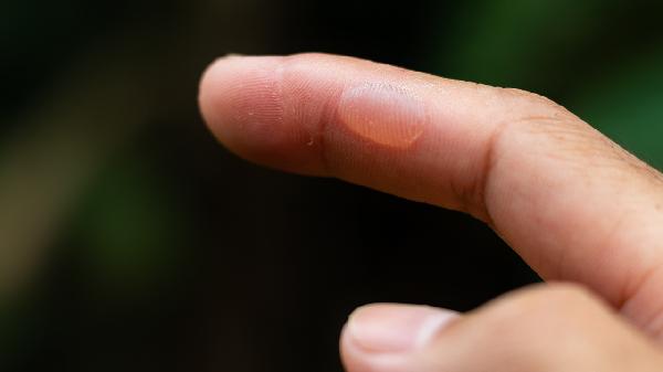 身體上出現(xiàn)水泡是怎么回事