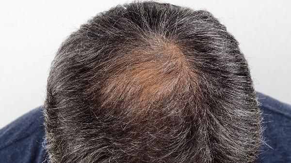 白頭發(fā)多怎么治療 四個(gè)方法改善白頭發(fā)多情況