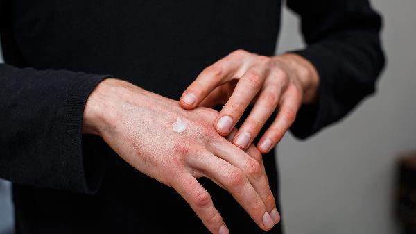 手部濕疹和手癬的區(qū)別是什么