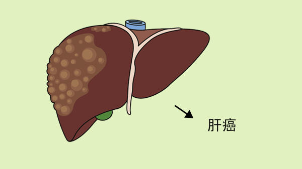 甲型肝炎抗体igm阴性是什么意思