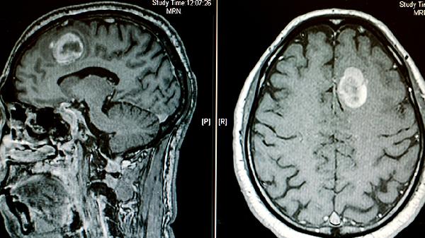 胃癌腦轉移有什么癥狀  胃癌腦轉移的4個癥狀很嚴重