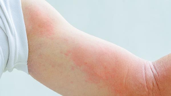急性荨麻疹能根治吗 掌握四招根除急性荨麻疹