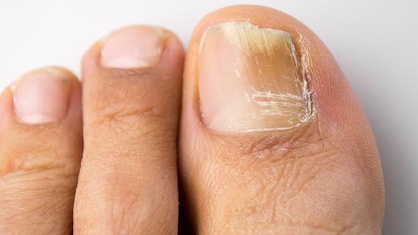 腳灰指甲怎么治療 腳灰腳指甲的3個(gè)療法須知