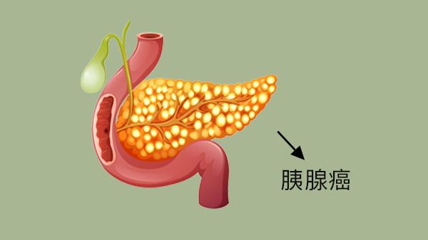 得了胰腺癌吃不下饭怎么办