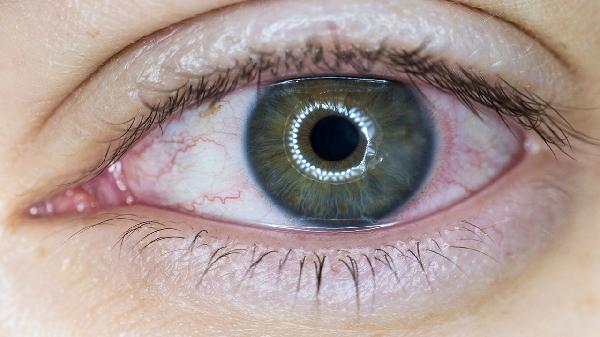 红眼病的6个注意事项揭秘 哪些原因会引起红眼病
