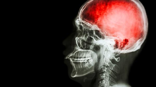 從哪些癥狀能判斷出新生兒腦癱