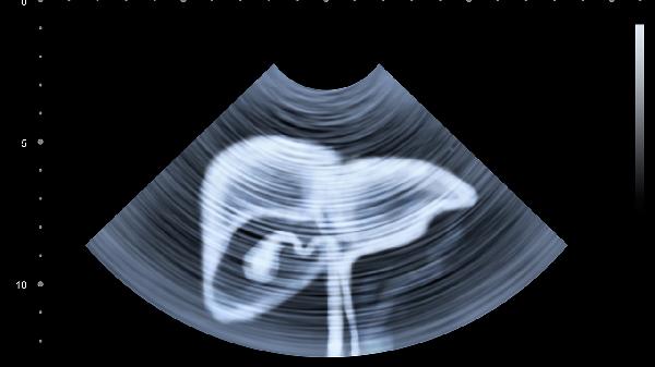女性运动后下腹部痛怎么缓解