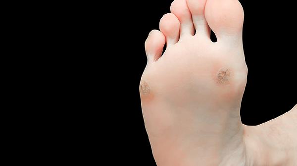 水泡型腳氣能不能扎破 水泡型腳氣的正確處理方法分享