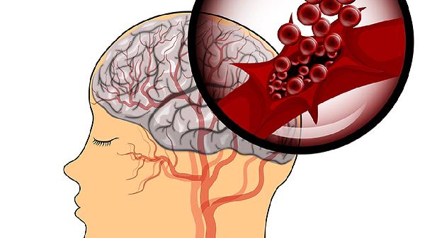 4类食物或是促发脑梗的“凶手”，现在忌口来得及，远离脑梗伤害