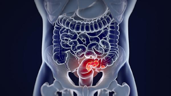 先天性腸閉鎖很嚴重嗎 簡述先天性腸閉鎖3大嚴重性