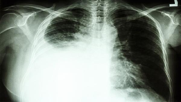 肺癌骨轉移晚期患者到死亡的癥狀