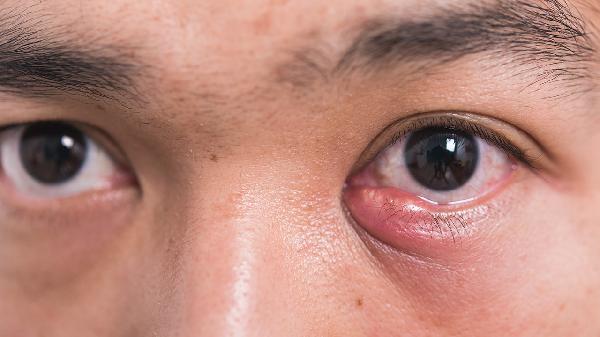 正常眼睛滴了妥布霉素有事吗
