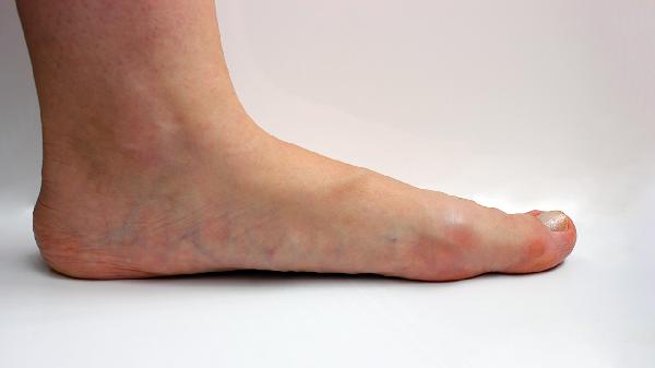 腳氣和腳臭一樣嗎   腳氣與腳臭有什么聯(lián)系