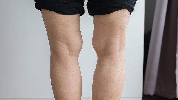 如何治疗x型腿 治疗x型腿的4个方法介绍