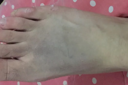 腳骨折了要花多少錢