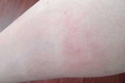 贴止痛膏过敏怎么处理
