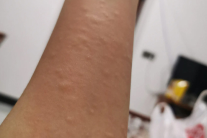 口水疹和湿疹的区别