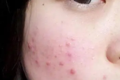 结节痘痘怎么处理