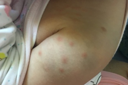 毛囊炎挤出来是白色的怎么回事