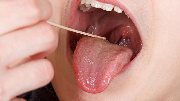 舌根腫脹咽喉腫脹怎么回事