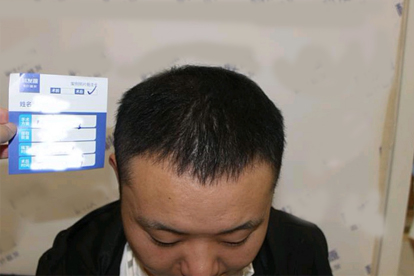 無痕植發(fā)效果好不好
